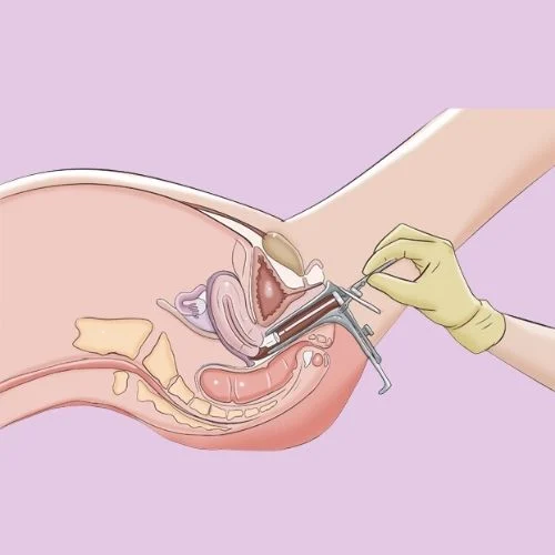 Smear testi sonrası kanama neden olur? 2 Smear Testi nedir?